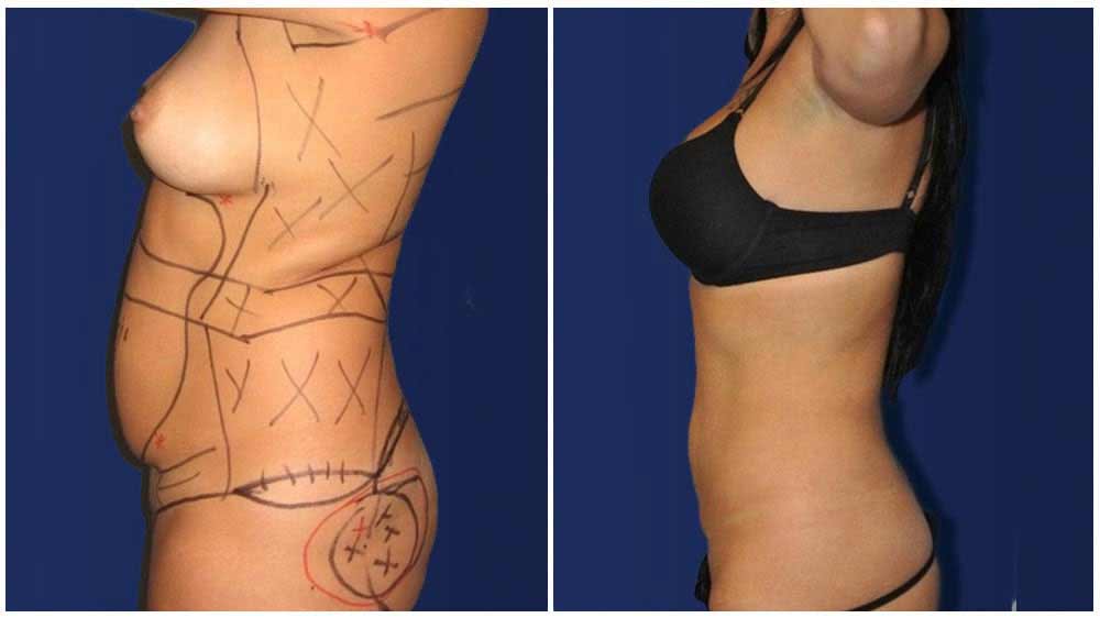 Fat Transfer of a Philadelphia Liposuction Specialty Clinic Female Patient - (30 years)