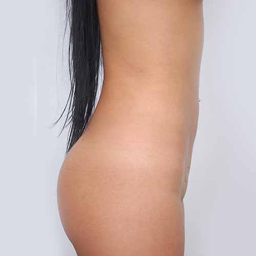 Liposuction Patient - After Picture